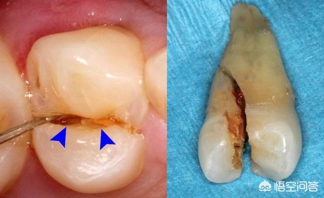 引起急性牙髓炎发作,二是阻生智齿容易塞牙,致病菌滋生感染周围牙龈