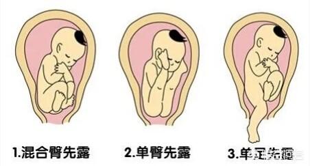 如图示,枕前位:胎儿背朝前胸向后,两手交叉于胸前,两腿盘曲,头俯曲,枕