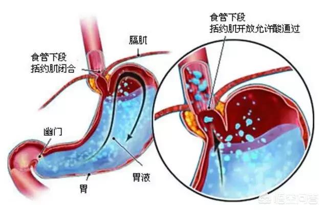 消化系统常见疾病检测:诊断胃食管反流病的检查项目有哪些？