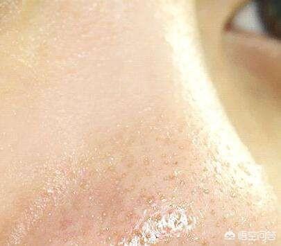 如何收缩鼻头毛孔(鼻头上的毛孔洞怎么收缩)