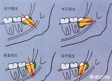 治疗牙痛有什么绝招，牙疼是怎么回事导致牙疼的原因有哪些