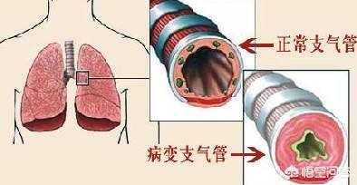 哮喘性支气管肺炎严重吗:小孩哮喘性支气管肺炎 支气管炎和肺炎的区别是什么？