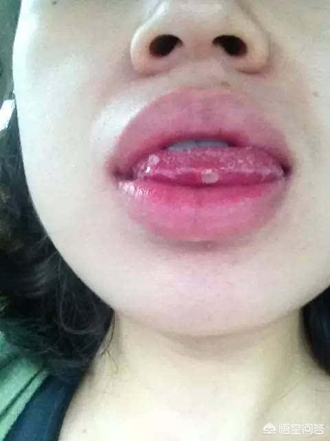 口腔溃疡是缺什么微量元素?-育儿网