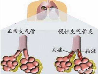 哮喘性支气管肺炎严重吗:小孩哮喘性支气管肺炎 支气管炎和肺炎的区别是什么？