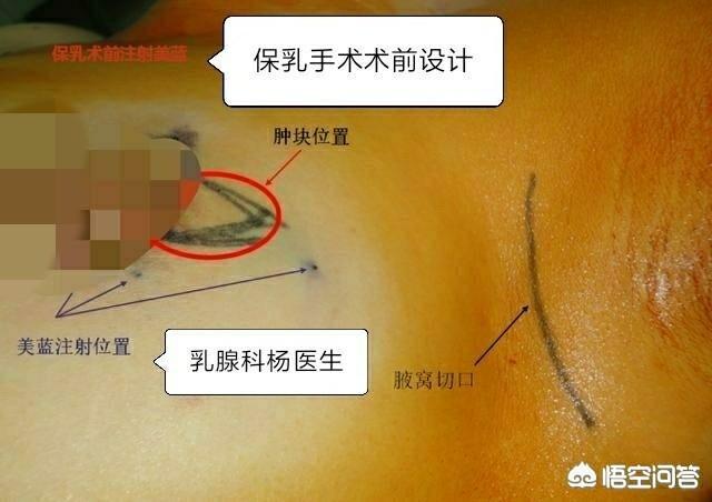 乳腺切除手术:做乳腺肿瘤切除手术时，麻醉该怎么打？需要注意什么？