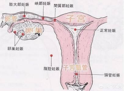 宫外孕的表现,宫外孕有什么征兆多久能查出来？