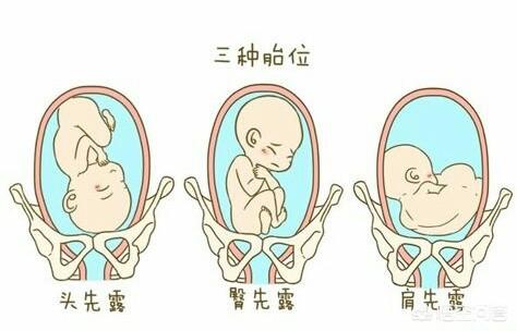 右枕后位胎儿图 胎位图片