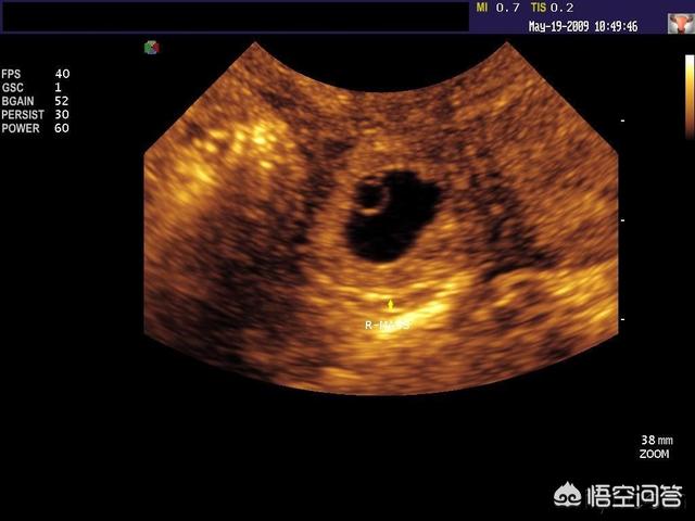 悟空问答 胎囊 胎芽 胎心到底是什么 36个回答