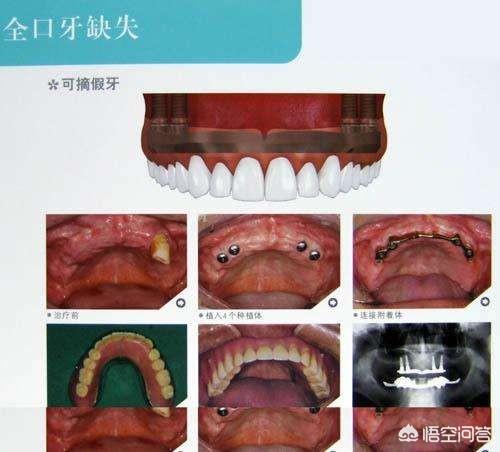 换多少颗牙齿:人的牙齿一般有多少颗算正常？