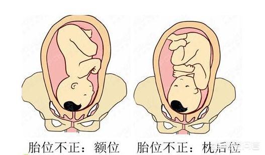 转胎位的姿势图图片