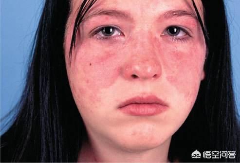 头条问答 - 天天面对电脑,脸上有一些小红块,跟电脑辐射有关吗?