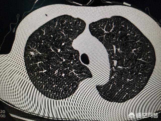 常规体检可以检测肺癌吗：体检能检测出肺癌吗