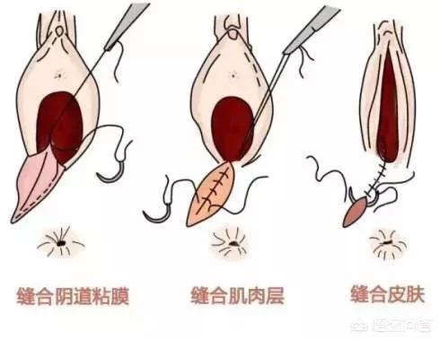 剖腹产什么时候可以洗澡，产后几天可以洗澡顺产和剖腹产是否有区别