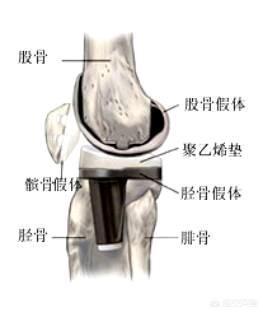 导致膝关节炎原因有哪些，膝关节炎有哪些好的改善办法