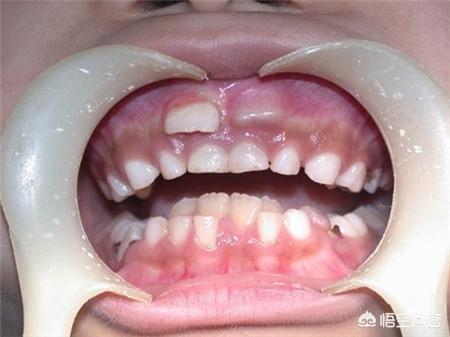 恒牙半年都没萌出是咋回事，七岁半孩子门牙在牙龈中半年，一直长不出来是怎么回事