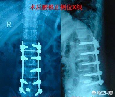 头条问答 腰椎盘突出 动一次手术需要多少钱 58个回答