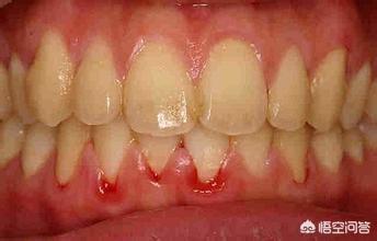 牙齿有点黄,洗牙伤牙齿吗？