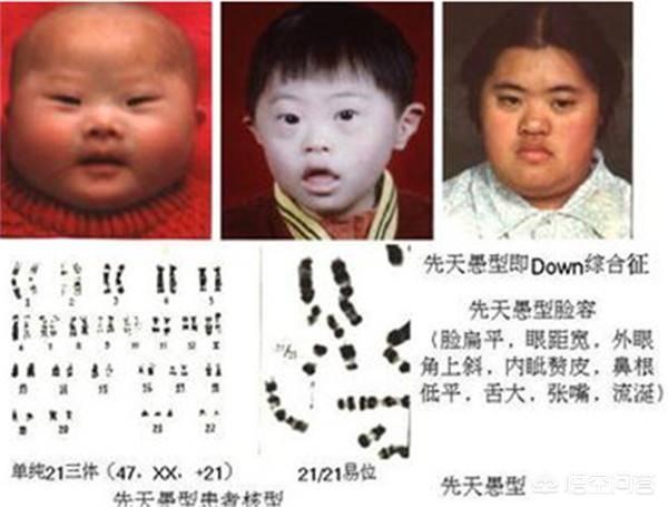 头条问答 唐氏综合征患者可以生育吗 38个回答