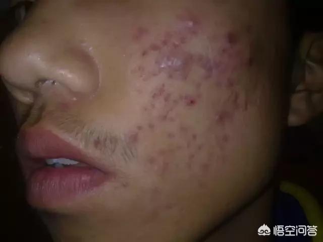 怎么预防青春痘(怎么预防青春痘?)