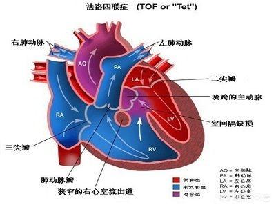 先天性心脏病:得了先天性心脏病能活多久？