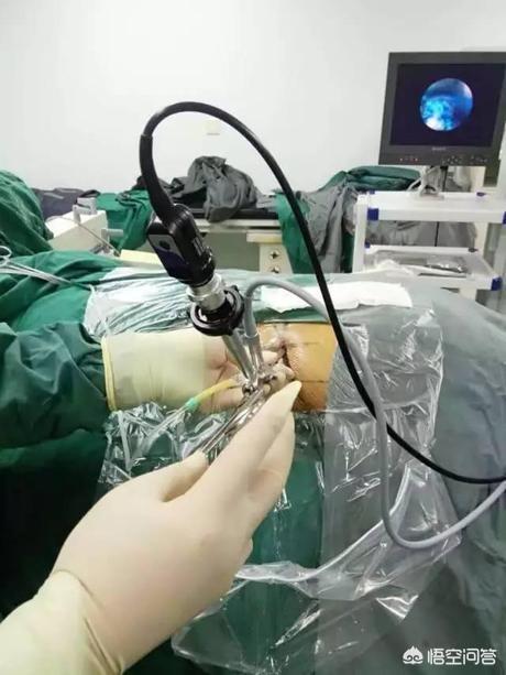 头条问答 腰椎盘突出 动一次手术需要多少钱 58个回答