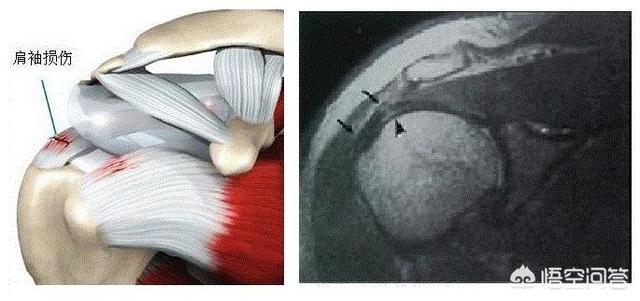 肩袖损伤为何发病率非常广泛，肩袖损伤是肩膀痛主要原因吗