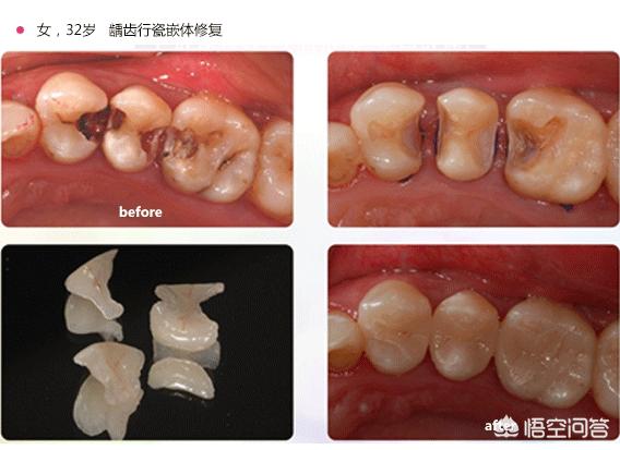 头条问答 - 邻面龋是怎么形成的?(2个回答)