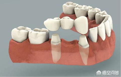 牙齒缺失是做種植牙好還是烤瓷牙好