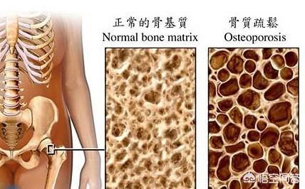 甲状腺机能减退与骨质疏松:得了骨质疏松，为什么会变矮？