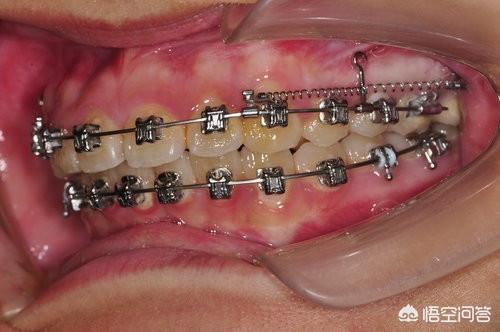 头条问答 牙齿矫正要打骨钉吗 为什么 7个回答