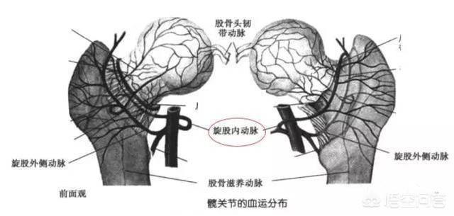 刘欢股骨头坏死:股骨头坏死的原因是什么？