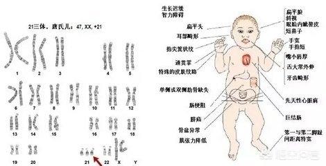 先天性心脏病:得了先天性心脏病能活多久？