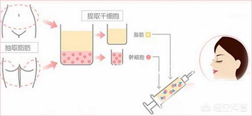 抱子寿星公:自体脂肪丰额头会变成寿星公吗？