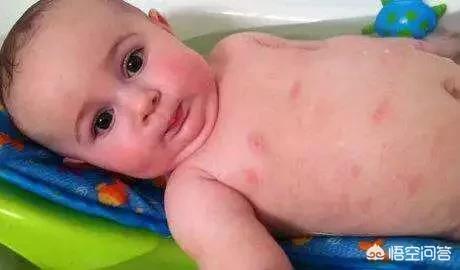 哺乳期螨虫叮咬后怎么处理:宝宝身上被螨虫咬的好多痘痘，该怎么办？