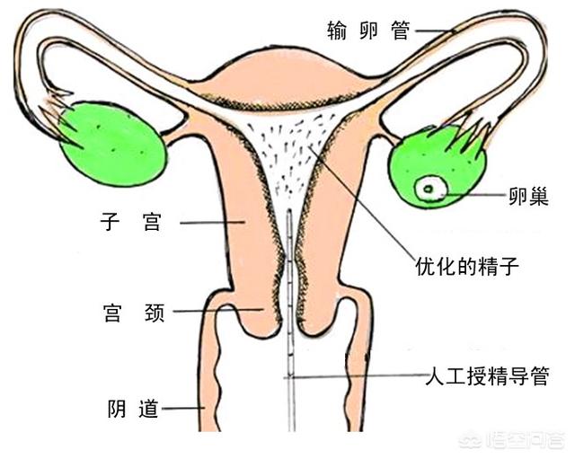 女体人工授精，如何看待中国单身女性去澳洲接受人工授精圆宝宝梦