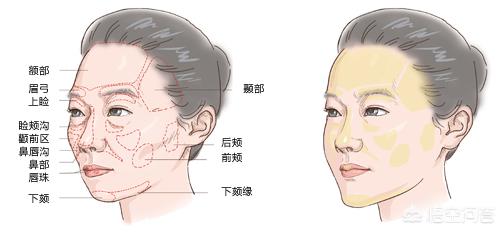 哪位美女做过自体脂肪填充面部啊？效果怎么样？脂肪成活率高吗？
