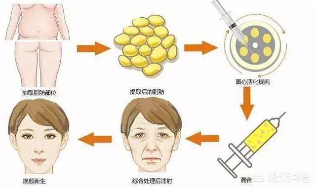 刘涛打瘦脸针面部凹陷，为什么打瘦脸针会出现面部下垂的现象