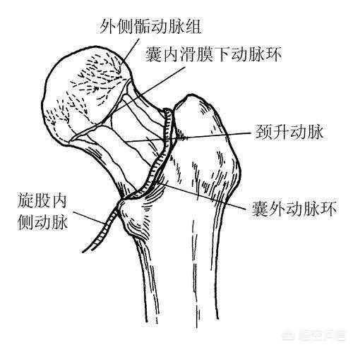 股骨颈骨折打钉示意图图片