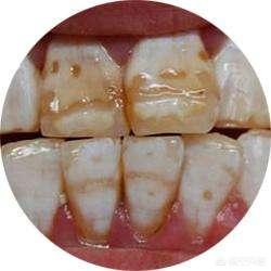 四环素牙齿(四环素牙齿美白价格大概多少左右)