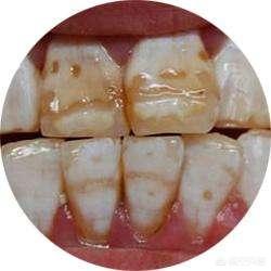 儿童四环素牙怎么治:儿童四环素牙怎么治疗 四环素牙可以通过洗牙洗掉吗，为什么？