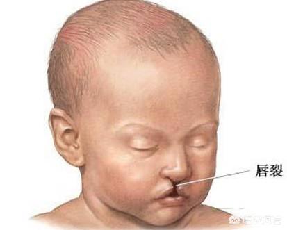 生兔唇宝宝是什么原因，兔唇是怎么形成的年纪大了要孩子会容易得兔唇吗