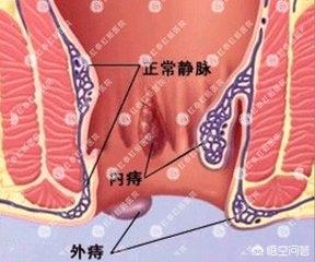 混合痔是怎么回事：混合痔一般是怎么形成的