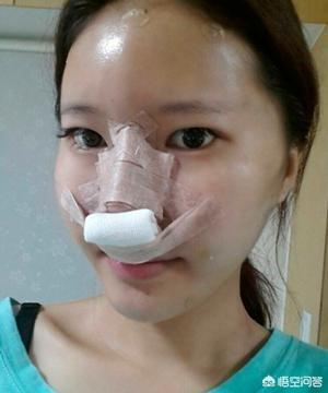假体隆鼻后遗症,假体隆鼻后都出现过哪些症状？