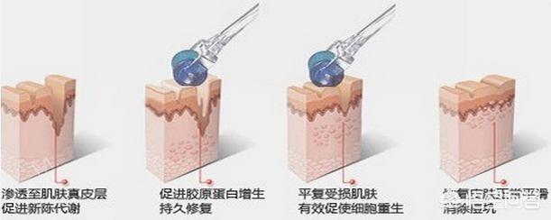 痘痘坑怎么消除(痘痘凹坑怎么修复)