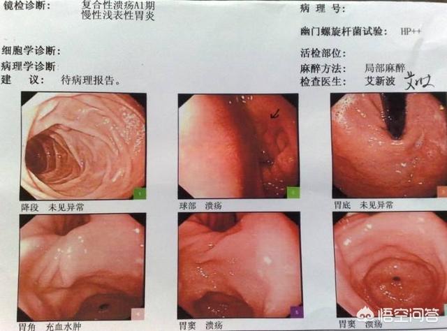 胃溃疡和胃癌的区别是什么?-百科网