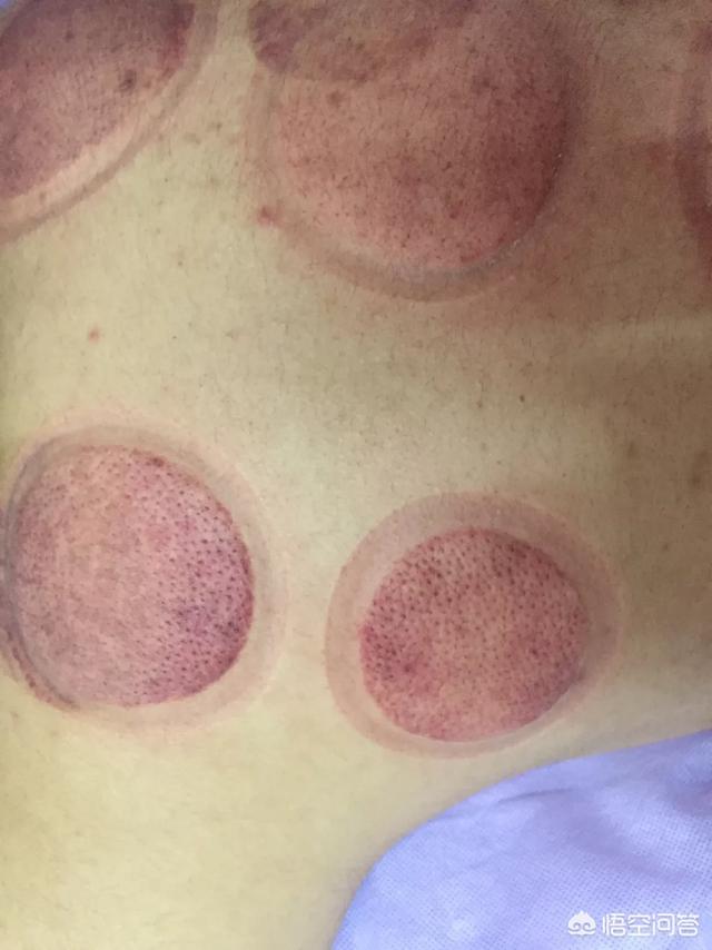 拔罐后长水泡究竟是什么问题?(8个回答)