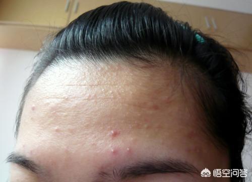额头出油长痘有什么办法解决吗