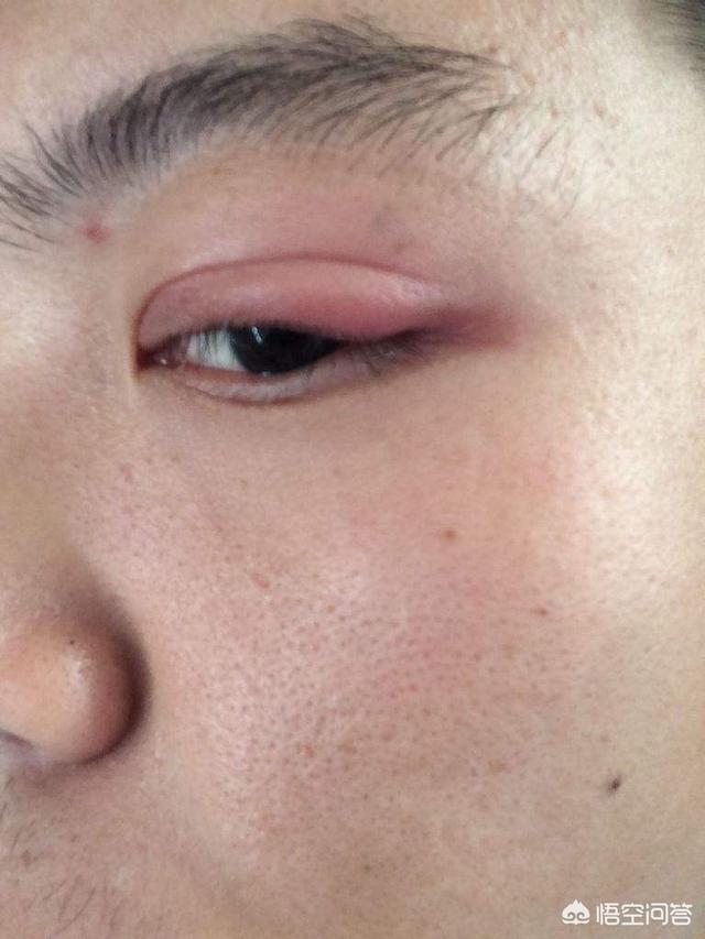 头条问答 - 为什么一早醒来眼睛会肿?怎样消肿?(39个回答)