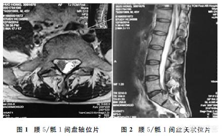 头条问答 腰椎盘突出 动一次手术需要多少钱 58个回答