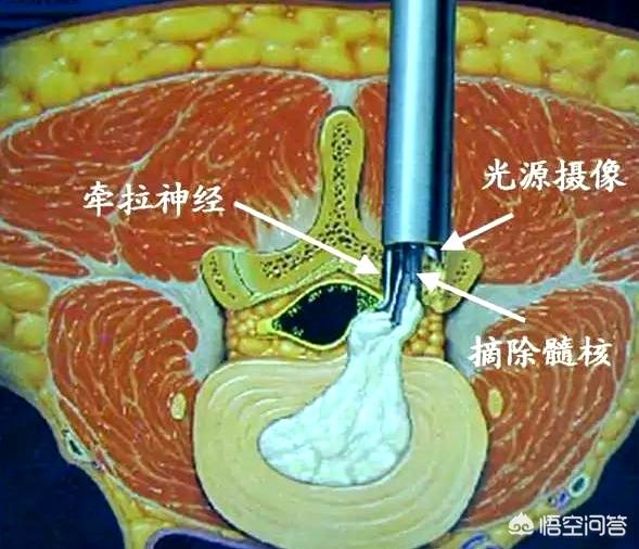 头条问答 腰椎盘突出 动一次手术需要多少钱 58个回答